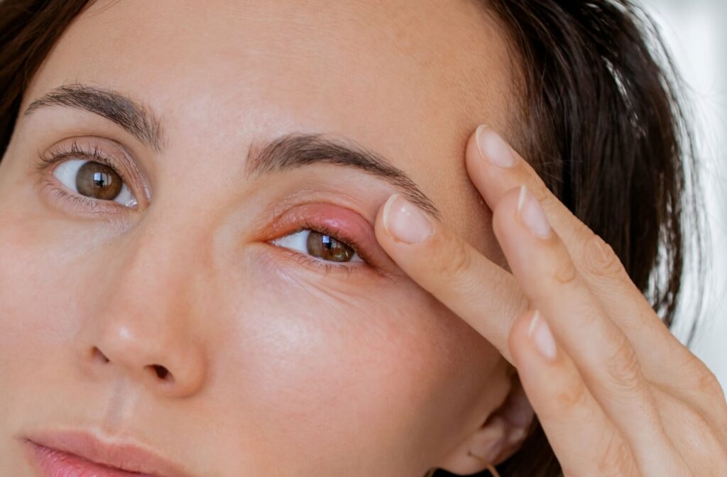 Adult person with a visible stye on the upper eyelid, gently touching the affected area.